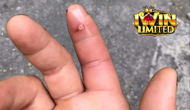 Mơ rắn xanh cắn vào ngón tay