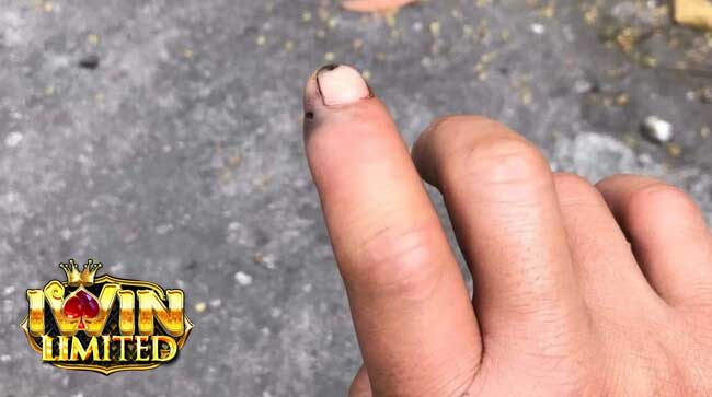 Mơ thấy rắn xanh cắn vào tay nhưng không chảy máu