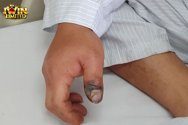 Rắn cắn ngón tay trỏ