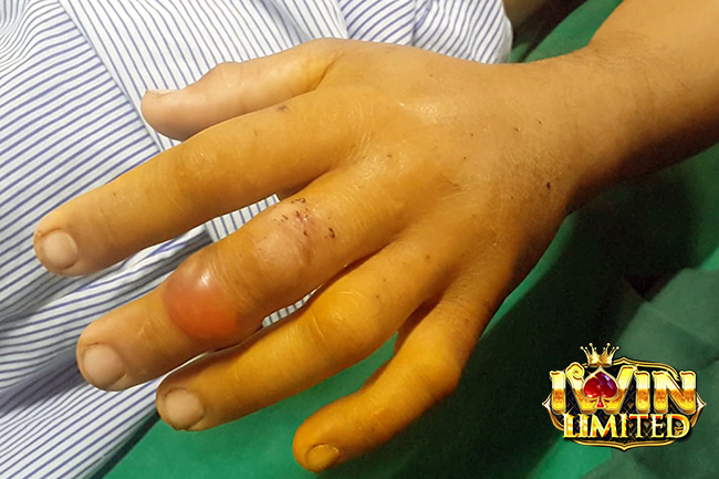 Mơ thấy rắn xanh cắn